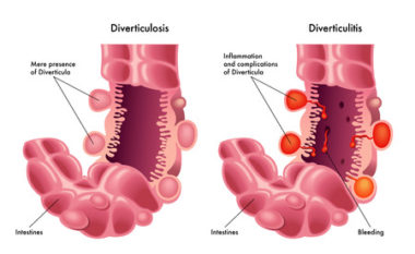 26362722 - diverticulosis and diverticulitis